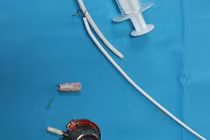 Lấy mảnh dị vật trong tim bệnh nhân suốt 6 năm