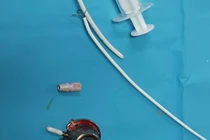 Lấy mảnh dị vật trong tim bệnh nhân suốt 6 năm