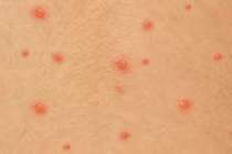 Thời điểm nào nên đi khám bệnh thủy đậu để tránh tử vong?