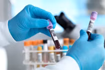 Xét nghiệm máu có thể chẩn đoán ung thư trong 30 phút