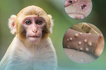 Bộ Y tế ban hành hướng dẫn chẩn đoán, điều trị, phòng bệnh đậu mùa khỉ 