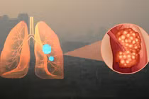 Hà Nội ô nhiễm không khí, cẩn trọng với loạt bệnh này