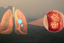 Hà Nội ô nhiễm không khí, cẩn trọng với loạt bệnh này