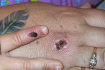 Phân biệt triệu chứng phát ban do zona với bệnh đậu mùa khỉ