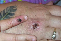 Phân biệt triệu chứng phát ban do zona với bệnh đậu mùa khỉ