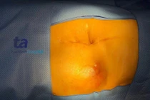 10 ngày xử lý khối u lớn, thoát vị ngoài thành bụng hiếm gặp