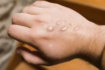 TP.HCM ghi nhận ca đậu mùa khỉ đầu tiên