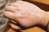 TP.HCM ghi nhận ca đậu mùa khỉ đầu tiên