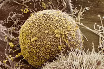 Nữ bệnh nhân HIV đầu tiên được chữa khỏi