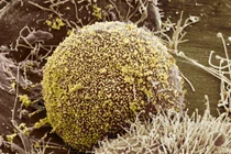 Nữ bệnh nhân HIV đầu tiên được chữa khỏi