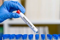 Điểm loạt triệu chứng thường gặp ở người nhiễm biến chủng Omicron