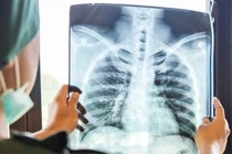 Phát hiện ung thư giai đoạn cuối với triệu chứng tưởng đơn giản