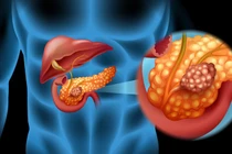 Triệu chứng cảnh báo sớm ung thư tuyến tụy ít người biết