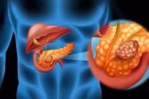 Triệu chứng cảnh báo sớm ung thư tuyến tụy ít người biết