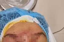 Mẹ bơm xe bị nổ lốp, mảnh vỡ làm hỏng mắt con trai