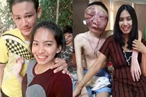 Cảm động cô gái nhất quyết ở bên bạn trai bị ung thư biến dạng mặt