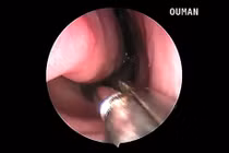 Video: Bác sỹ gắp con vắt sống trong lỗ mũi hơn 1 tháng