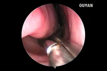 Video: Bác sỹ gắp con vắt sống trong lỗ mũi hơn 1 tháng