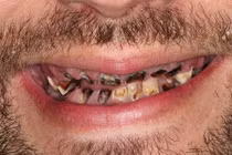 Hàm răng chàng trai thối rữa do nghiện loại đồ uống quen thuộc