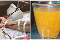 4 loại đồ uống càng uống càng gây xơ gan, suy thận