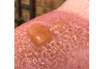 Bỏng cấp độ 2 vì cởi trần làm việc ngoài trời nắng