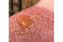 Bỏng cấp độ 2 vì cởi trần làm việc ngoài trời nắng