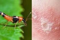 Hoảng hồn nam thanh niên tự chữa bệnh ngoài da bằng "bã" kiến ba khoang