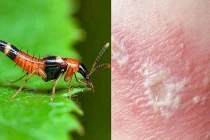 Hoảng hồn nam thanh niên tự chữa bệnh ngoài da bằng "bã" kiến ba khoang