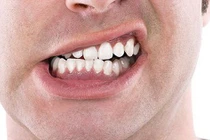 Bạn có biết 7 thói quen hằng ngày đang hủy hoại hàm răng