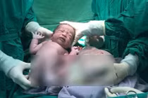 Kinh ngạc bé gái song sinh chào đời còn nguyên trong túi ối