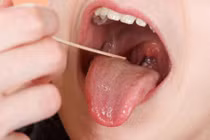 Soi những triệu chứng ung thư lưỡi