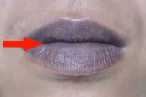 3 biểu hiện trên khuôn mặt cho thấy bạn có thể đang mắc bệnh gan