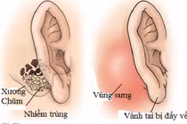 Tai có mùi hôi thối - triệu chứng của nhiều bệnh lý nguy hiểm