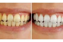 Răng trắng như bọc sứ, chấm dứt hôi miệng chỉ với 1 nghìn đồng!