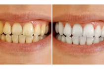 Răng trắng như bọc sứ, chấm dứt hôi miệng chỉ với 1 nghìn đồng!