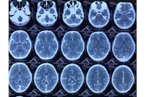 Đau đầu thiếu nữ bất ngờ phát hiện dị dạng mạch não