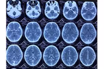 Đau đầu thiếu nữ bất ngờ phát hiện dị dạng mạch não