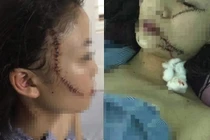 Tâm sự đẫm nước mắt của chị cô gái bị tấn công phải khâu 60 mũi