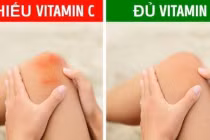 Những dấu hiệu cảnh báo bạn thiếu vitamin C trầm trọng