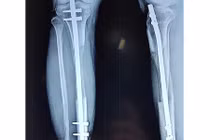 Ca phẫu thuật kéo dài chân kỷ lục ở Việt Nam