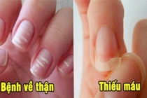6 dấu hiệu ở móng tay cảnh báo bệnh nguy hiểm, đừng chủ quan