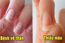 6 dấu hiệu ở móng tay cảnh báo bệnh nguy hiểm, đừng chủ quan