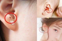 Nốt ruồi ở tai nói lên điều gì về tương lai của bạn?