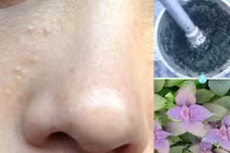 Không cần dùng tia laser mụn thịt cũng bay hết với lá này