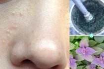 Không cần dùng tia laser mụn thịt cũng bay hết với lá này