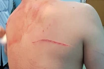 Điểm bất thường trong vụ bác sĩ Chiêm Quốc Thái bị côn đồ chém