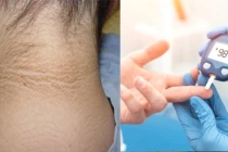 Người có đường huyết cao thường thấy 5 biểu hiện này 