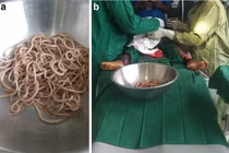 Tưởng bị táo bón, bác sĩ gắp ra từ ruột bé trai 4 tuổi cả chậu giun
