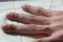 4 triệu chứng trên ngón tay cho thấy chất độc trong cơ thể đang bùng phát