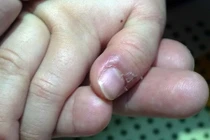 Xước măng rô tay, chân: Cách xử lý đơn giản nhưng ít người biết